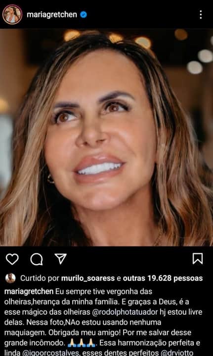 Gretchen fica feliz com resultado do procedimento estético nas olheiras Gretchen fica feliz com resultado do procedimento estético nas olheiras