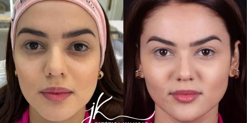Antes e depois de Eslovênia Marques (DIVULGAÇÃO/ JK ESTÉTICA AVANÇADA) Antes e depois de Eslovênia Marques (DIVULGAÇÃO/ JK ESTÉTICA AVANÇADA)