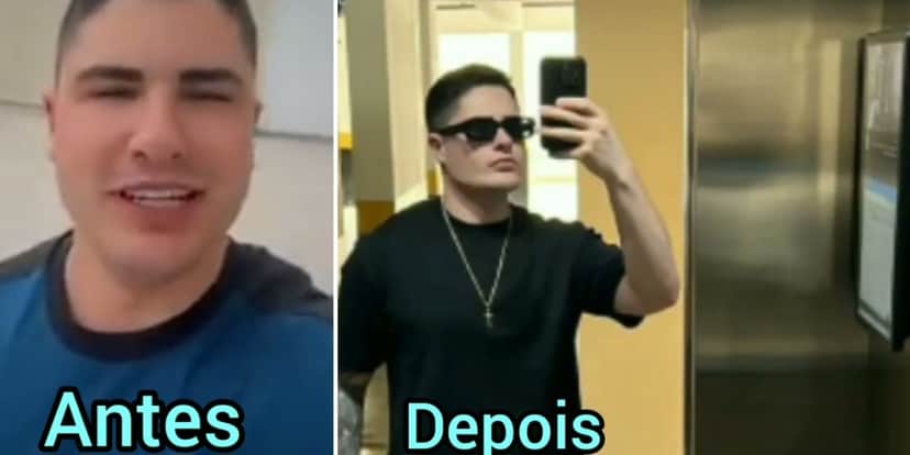 Lucas Souza antes e depois de harmonização facial (Foto> Reprodução Instagram) Lucas Souza antes e depois de harmonização facial (Foto> Reprodução Instagram)