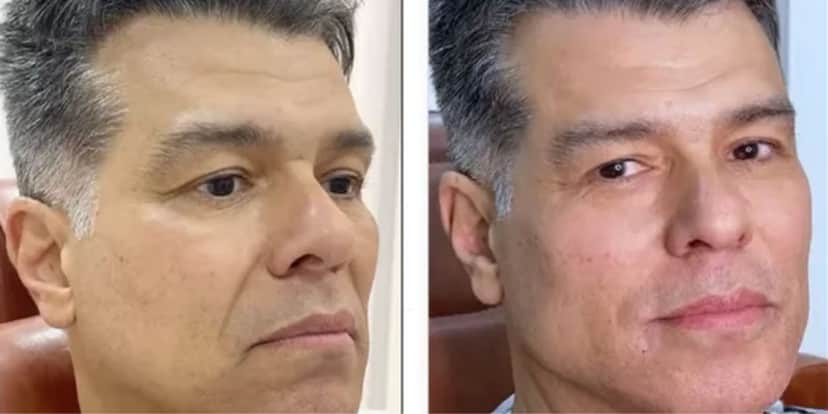 Ator Maurício Mattar antes e depois da harmonização facial - Foto: Reprodução Instagram Ator Maurício Mattar antes e depois da harmonização facial - Foto: Reprodução Instagram