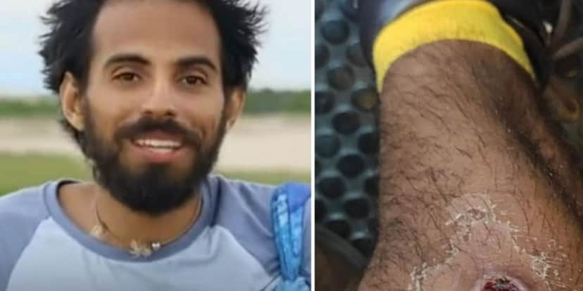 Lucas Santana mostrou ferimento infeccionado nos bastidores de "No Limite" Lucas Santana mostrou ferimento infeccionado nos bastidores de "No Limite"