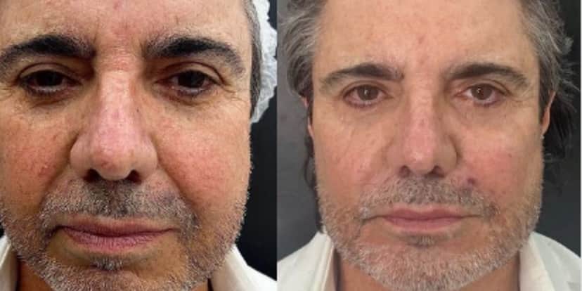 "Milagre": João Kleber mostra antes e depois de harmonização facial "Milagre": João Kleber mostra antes e depois de harmonização facial