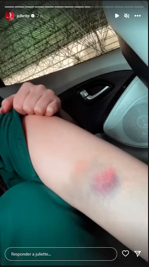Juliette exibiu hematomas em seu corpo (Imagem: Reprodução) Juliette exibiu hematomas em seu corpo (Imagem: Reprodução)
