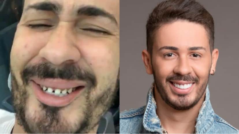 Carlinhos Maia antes e depois das lentes nos dentes (Reprodução) Carlinhos Maia antes e depois das lentes nos dentes (Reprodução)