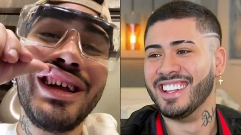 MC Kevinho antes e depois das lentes nos dentes (Reprodução) MC Kevinho antes e depois das lentes nos dentes (Reprodução)