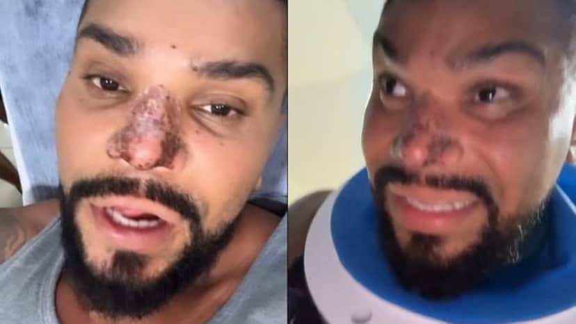 Naldo Benny está com parte do rosto deformado por causa de uma rinomodelação que não deu certo (Foto: Reprodução / Instagram) Naldo Benny está com parte do rosto deformado por causa de uma rinomodelação que não deu certo (Foto: Reprodução / Instagram)