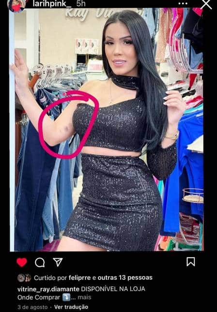 Larissa Novais exibindo os hematomas em seus braços (Imagem: Reprodução) Larissa Novais exibindo os hematomas em seus braços (Imagem: Reprodução)