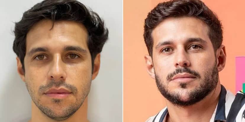 Rodrigo Mussi, do BBB 22, antes e depois do procedimento - Foto: Reprodução/ TV FOCO Rodrigo Mussi, do BBB 22, antes e depois do procedimento - Foto: Reprodução/ TV FOCO