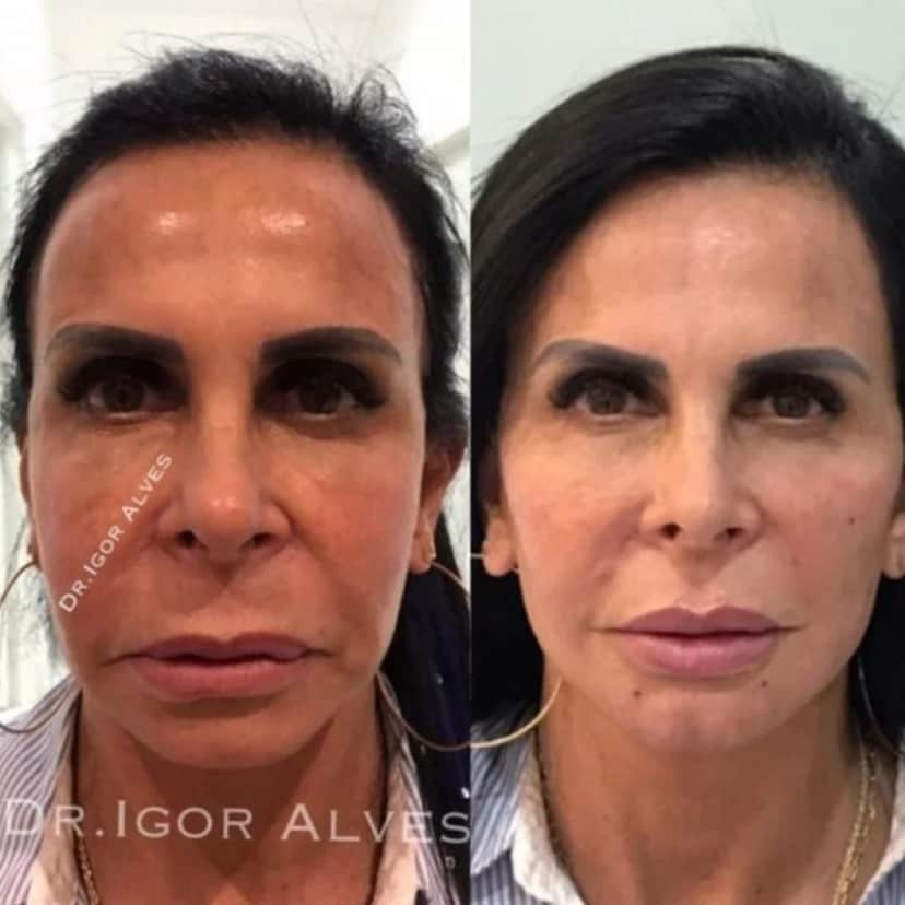 Gretchen surpreendeu os fãs ao aparecer 20 anos mais nova (Reprodução - Instagram) Gretchen surpreendeu os fãs ao aparecer 20 anos mais nova (Reprodução - Instagram)