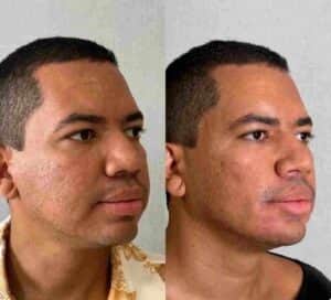 Bruno Gaga do BBB23, mostrou o antes e o depois de procedimento estético (Foto: Reprodução / Instagram) Bruno Gaga do BBB23, mostrou o antes e o depois de procedimento estético (Foto: Reprodução / Instagram)