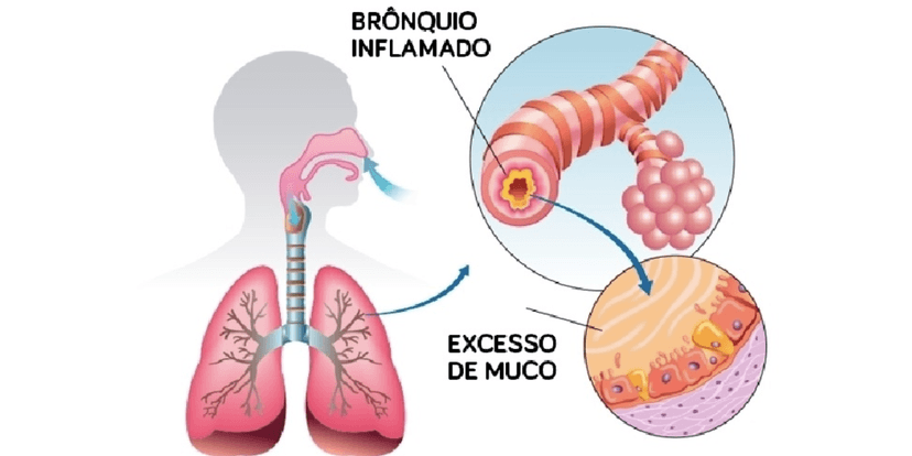 Bronquiolite (Reprodução/Internet) Bronquiolite (Reprodução/Internet)