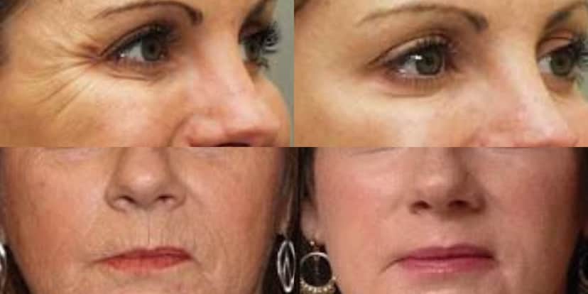 Botox Caseiro (Foto: Divulgação) Botox Caseiro (Foto: Divulgação)