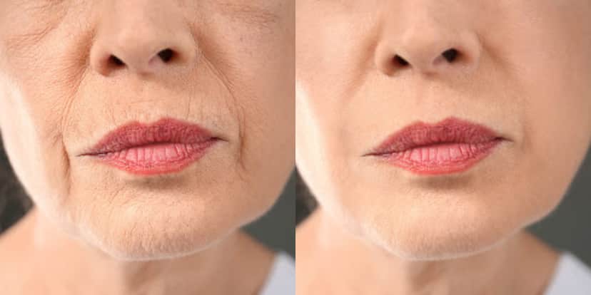 Pele perfeita usando colágeno natural (Foto: Divulgação) Pele perfeita usando colágeno natural (Foto: Divulgação)