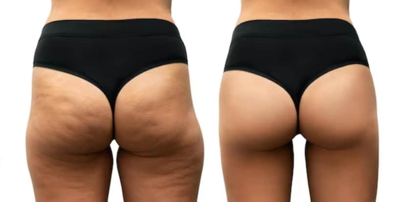 Celulite antes e depois de dicas (Foto: Divulgação) Celulite antes e depois de dicas (Foto: Divulgação)
