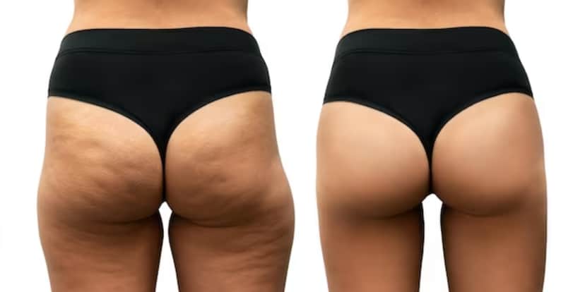Celulite antes e depois de dicas (Foto: Divulgação) Celulite antes e depois de dicas (Foto: Divulgação)