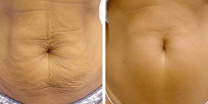 Antes e depois da barriga flácida - (Foto: Reprodução / Internet) Antes e depois da barriga flácida - (Foto: Reprodução / Internet)