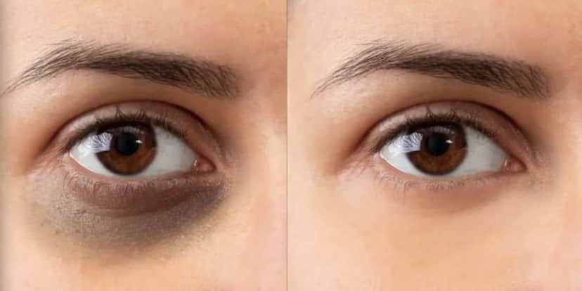 Olheiras profundas antes e depois (Reprodução/Internet) Olheiras profundas antes e depois (Reprodução/Internet)