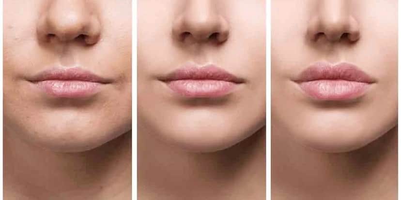 Lábios após Preenchimento labial (Foto: Reprodução, Clínica Carreirão) Lábios após Preenchimento labial (Foto: Reprodução, Clínica Carreirão)