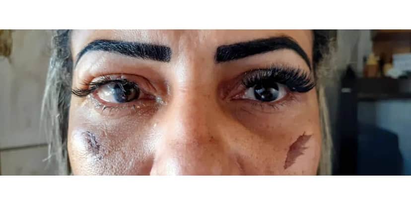 Mulher teve lesão nos olhos após colocar cílios postiços em clínica de estética (Foto: Internet) Mulher teve lesão nos olhos após colocar cílios postiços em clínica de estética (Foto: Internet)