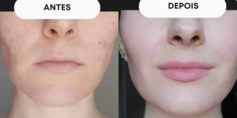 Harmonização facial caseira te livra de rugas e rosto caído (Foto: Divulgação)