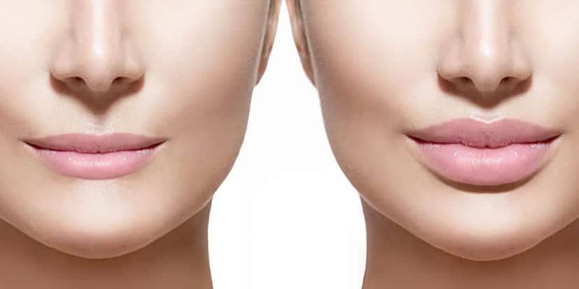 Exercícios para ajudar no preenchimento labial (Reprodução: Internet) Exercícios para ajudar no preenchimento labial (Reprodução: Internet)