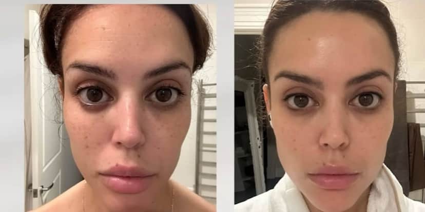 Dá para perceber a redução das rugas na testa de Renata Meinz (Reprodução: Youtube) Dá para perceber a redução das rugas na testa de Renata Meinz (Reprodução: Youtube)
