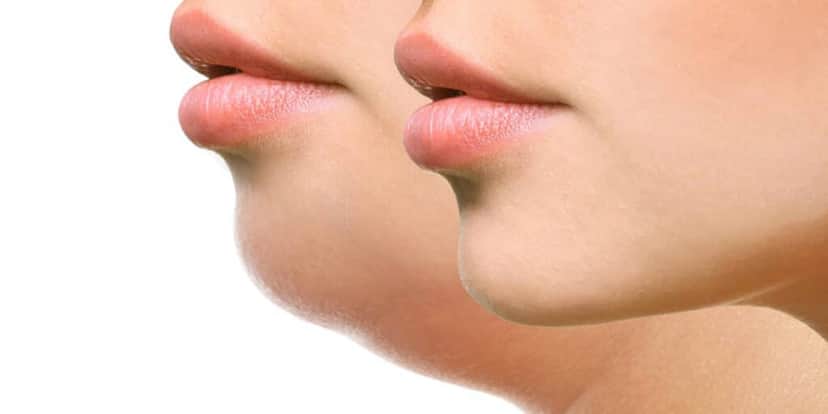 Antes e Depois: Mulher com e sem papada (Foto: Reprodução - SmartLIPO) Antes e Depois: Mulher com e sem papada (Foto: Reprodução - SmartLIPO)