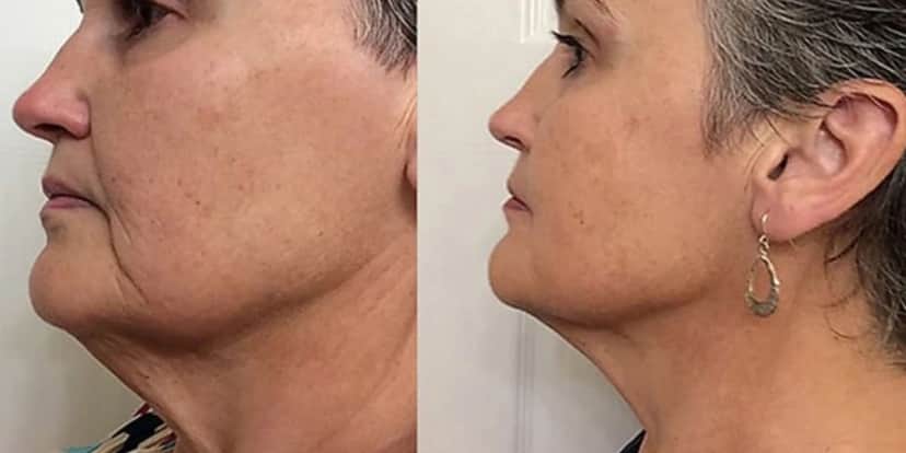 Mulher com e sem rugas (Foto: Reprodução / Portal g97) Mulher com e sem rugas (Foto: Reprodução / Portal g97)