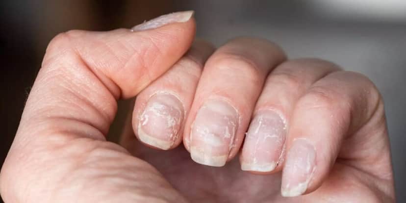 Unhas quebradiças (Foto: Reprodução/ Internet) Unhas quebradiças (Foto: Reprodução/ Internet)