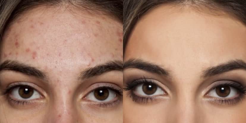 Espinhas e manchas antes e depois (Foto: Divulgação) Espinhas e manchas antes e depois (Foto: Divulgação)