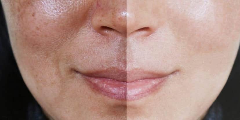 Rosto após dar adeus a melasma (Reprodução: Internet) Rosto após dar adeus a melasma (Reprodução: Internet)
