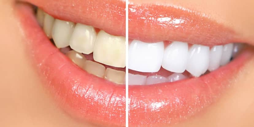 Clareamento te deixa com dentes brancos e sem bafo (Foto: Divulgação) Clareamento te deixa com dentes brancos e sem bafo (Foto: Divulgação)