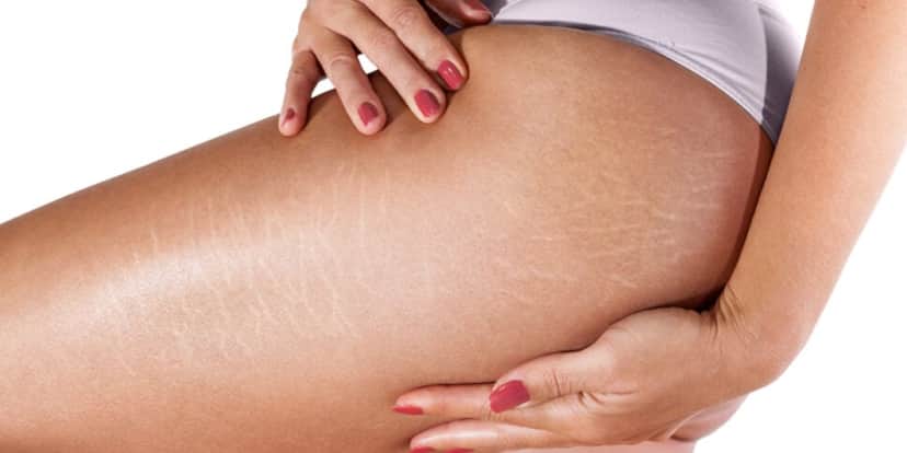 http://tvfoco.uai.com.br/wp-Estrias incomodam muitas mulheres (Foto: Divulgação/Internet)/uploads/2015/05/Daniela-Mercury.jpg http://tvfoco.uai.com.br/wp-Estrias incomodam muitas mulheres (Foto: Divulgação/Internet)/uploads/2015/05/Daniela-Mercury.jpg