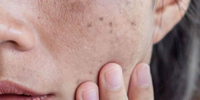 Dê adeus as manchas escuras e melasma (Reprodução: Internet) Dê adeus as manchas escuras e melasma (Reprodução: Internet)