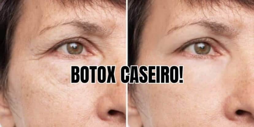 Botox caseiro dexa você 20 mais jovem e com pele mais linda que das famosas - Foto: Internet Botox caseiro dexa você 20 mais jovem e com pele mais linda que das famosas - Foto: Internet