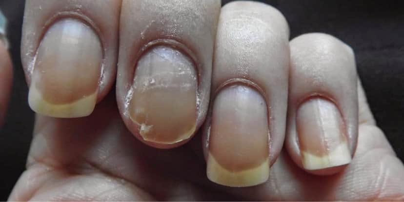 As unhas quebradas Reprodução: Internet) As unhas quebradas Reprodução: Internet)