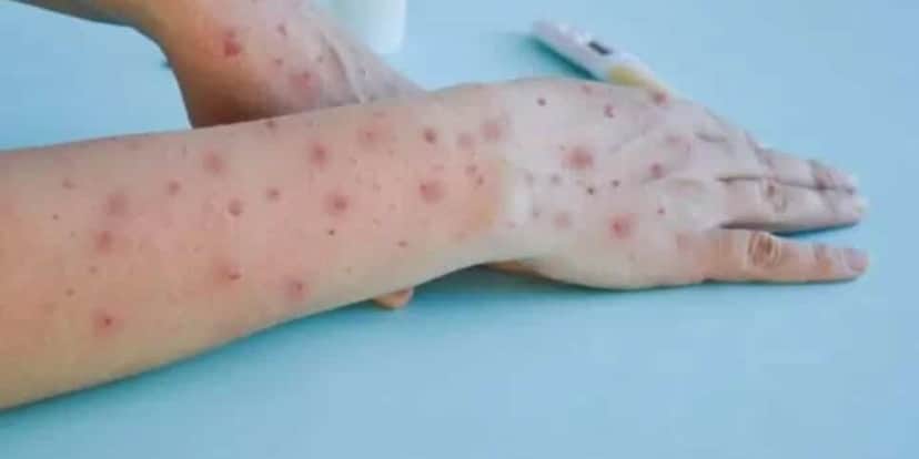 Feridas em forma de bolinhas é o principal sintoma da mpox (Reprodução/Diário do Nordeste) Feridas em forma de bolinhas é o principal sintoma da mpox (Reprodução/Diário do Nordeste)