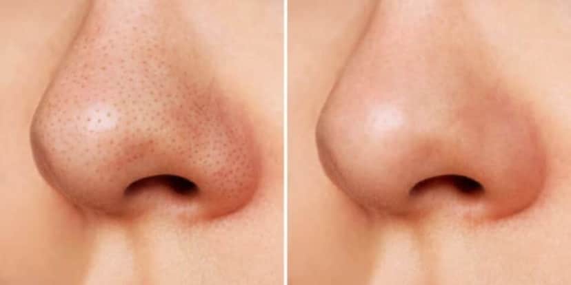 Antes e depois dos cravos no nariz (Reprodução/Freepik) Antes e depois dos cravos no nariz (Reprodução/Freepik)