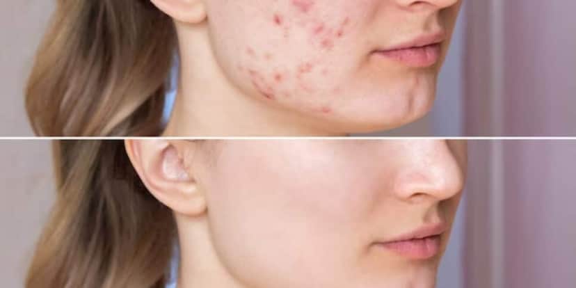 Antes e depois de cravos e espinhas (Foto: Freepik) Antes e depois de cravos e espinhas (Foto: Freepik)