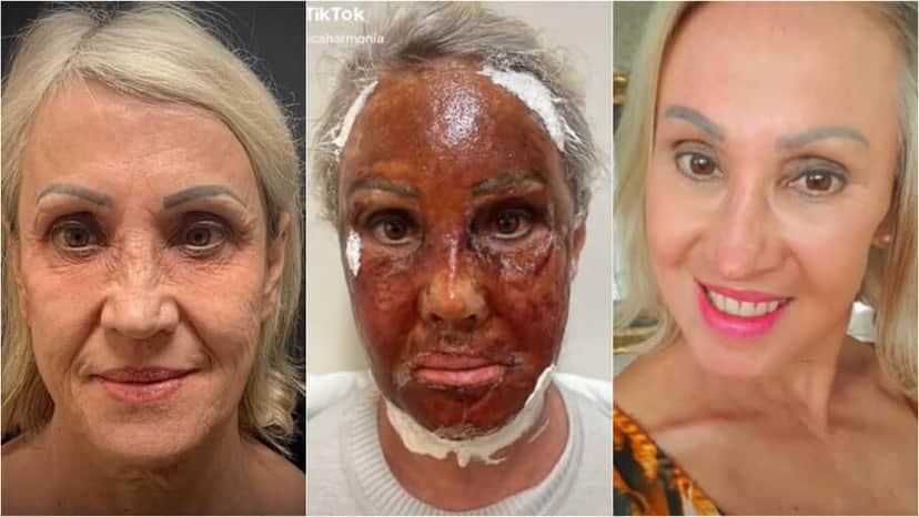 O peeling é um dos principais tratamentos contra manchas e olheiras (Foto Reprodução/Montagem/Tv Foco) O peeling é um dos principais tratamentos contra manchas e olheiras (Foto Reprodução/Montagem/Tv Foco)
