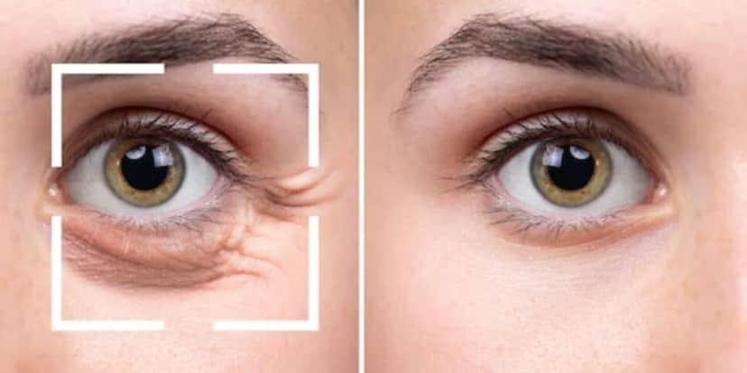 Mulher com e sem olheiras (Foto: Freepik) Mulher com e sem olheiras (Foto: Freepik)