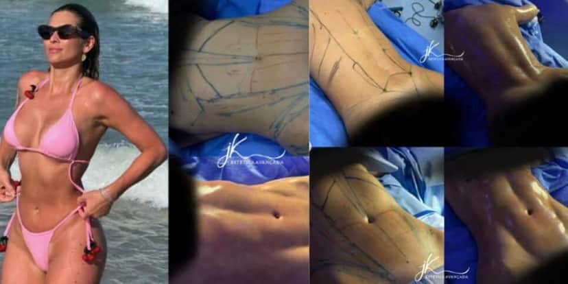 Lipo LAD da apresentadora (Reprodução/Instagram) Lipo LAD da apresentadora (Reprodução/Instagram)