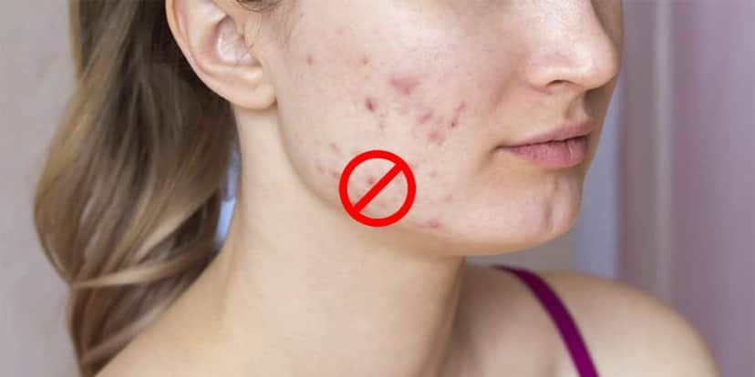 Adeus espinhas e manchas na pele com essa receita (Foto: Divulgação) Adeus espinhas e manchas na pele com essa receita (Foto: Divulgação)