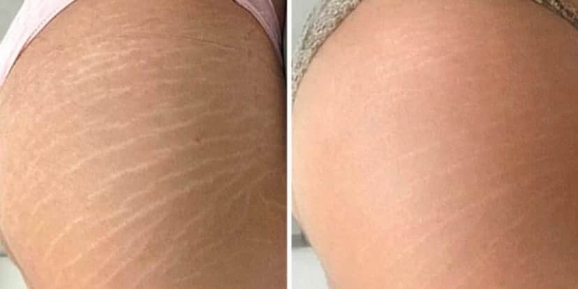 Único ingrediente popular acaba com estrias das 50+ e traz melhor colágeno do mundo - Foto: Internet Único ingrediente popular acaba com estrias das 50+ e traz melhor colágeno do mundo - Foto: Internet