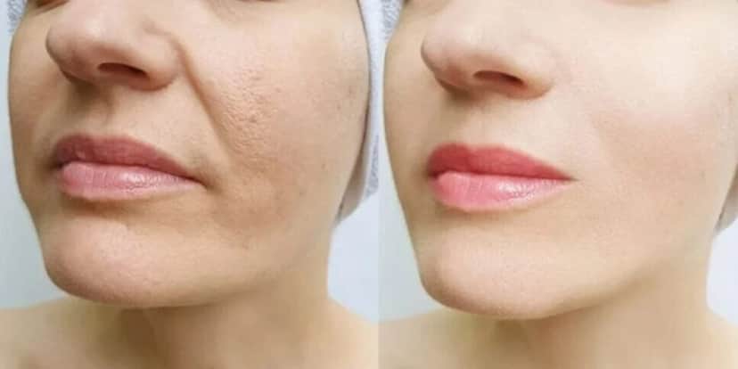 Harmonização facial caseira em 5 minutos traz resultado IMEDIATO e fim das rugas - Foto: Internet Harmonização facial caseira em 5 minutos traz resultado IMEDIATO e fim das rugas - Foto: Internet
