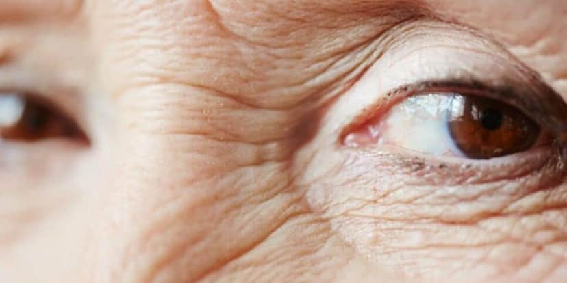 Pé de galinha fica mais em evidência a partir dos 50 anos (Reprodução: Internet) Pé de galinha fica mais em evidência a partir dos 50 anos (Reprodução: Internet)
