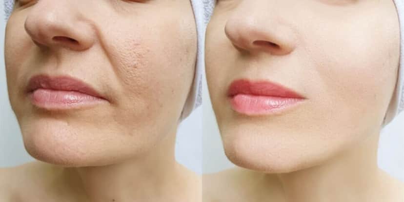 Adeus rugas: 1 ingrediente secreto elimina rugas e estica pele em 30 minutos - Foto: Internet Adeus rugas: 1 ingrediente secreto elimina rugas e estica pele em 30 minutos - Foto: Internet