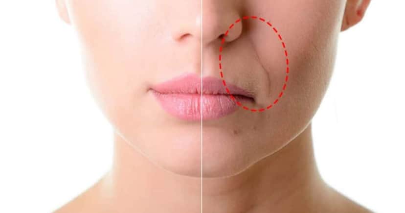 Graças a essa receita você vai se livrar do bigode chinês e das rugas (Foto: Montagem) Graças a essa receita você vai se livrar do bigode chinês e das rugas (Foto: Montagem)