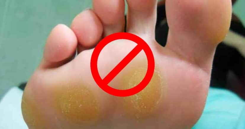 Com simples receita, você vai acabar com o pesadelo de calos nos pés (Foto: Montagem) Com simples receita, você vai acabar com o pesadelo de calos nos pés (Foto: Montagem)