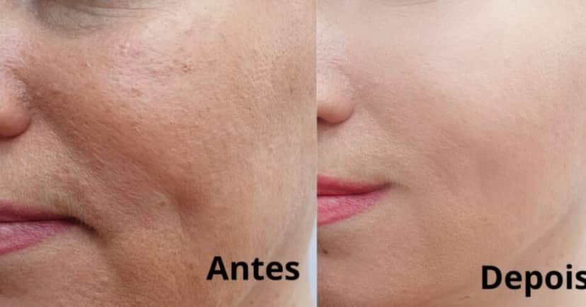 3 receitas de harmonização facial caseira que dão fim às rugas e rejuvenesce às 50+ em minutos - Foto: Internet 3 receitas de harmonização facial caseira que dão fim às rugas e rejuvenesce às 50+ em minutos - Foto: Internet